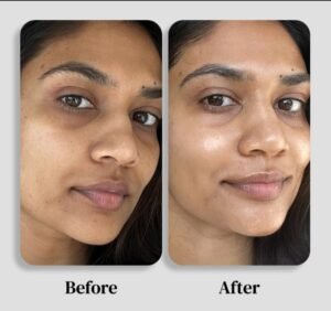 Dark Spots Removal